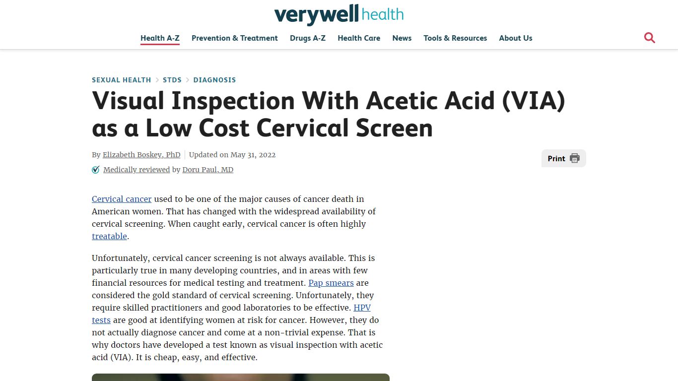 Visual Inspection With Acetic Acid (VIA) Test - Verywell Health